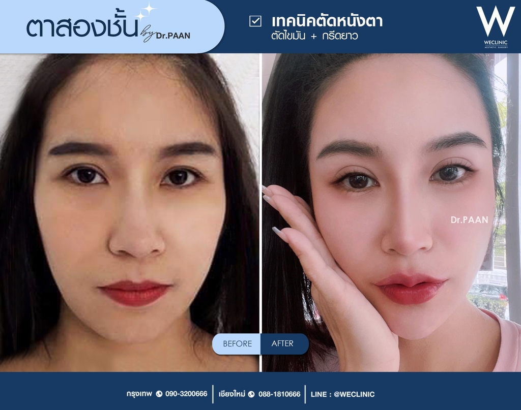 รีวิวตาสองชั้น-E06