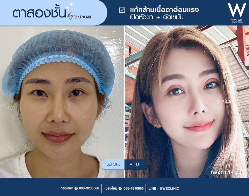 รีวิวตาสองชั้น-E07
