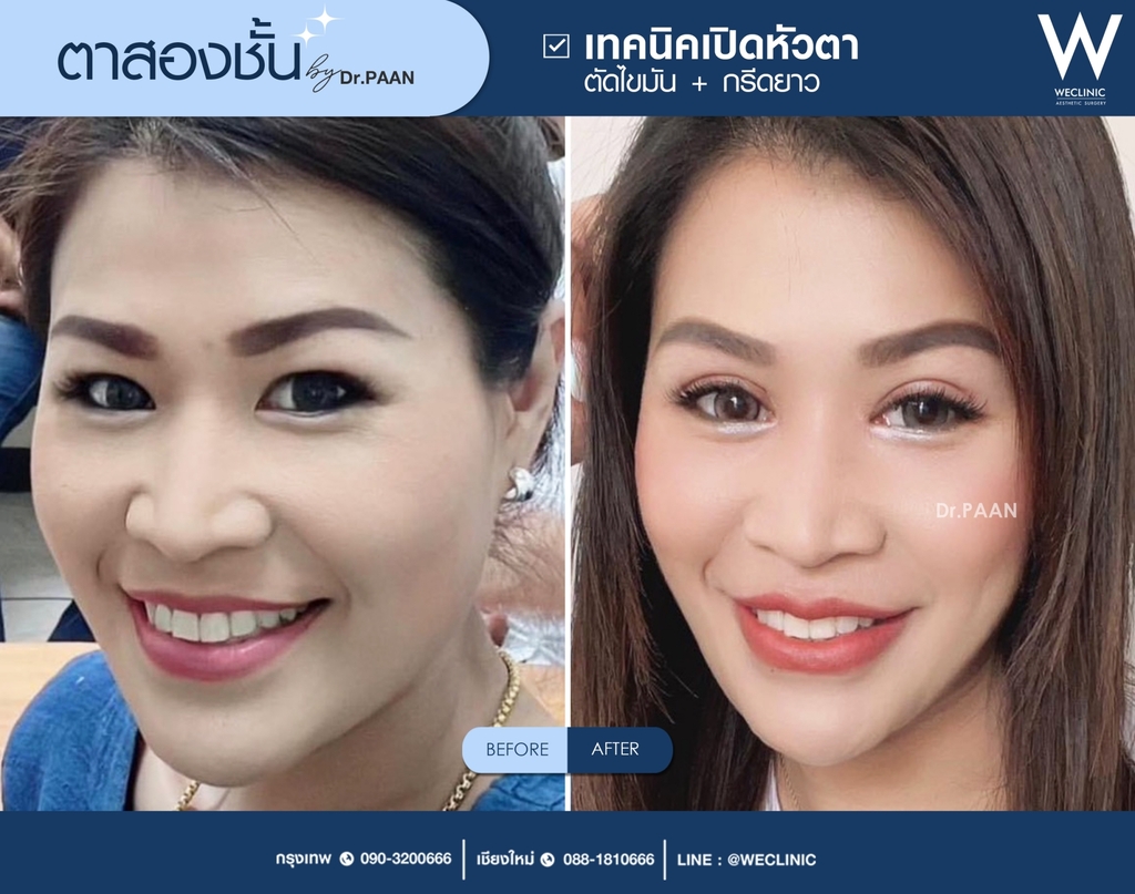 รีวิวตาสองชั้น-E08