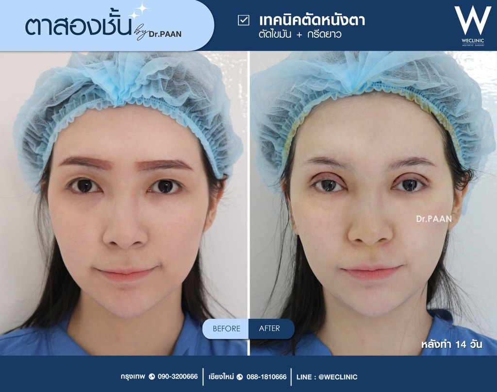 รีวิวตาสองชั้น-E09