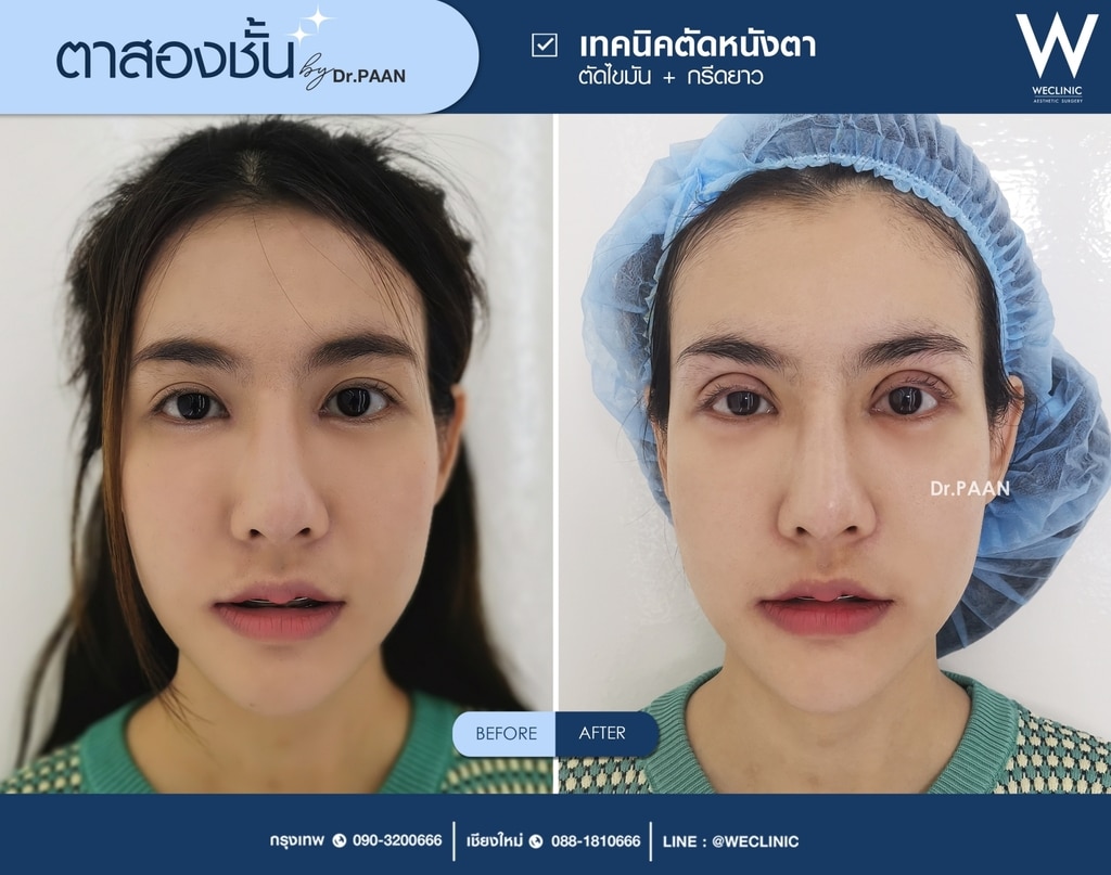 รีวิวตาสองชั้น-E10