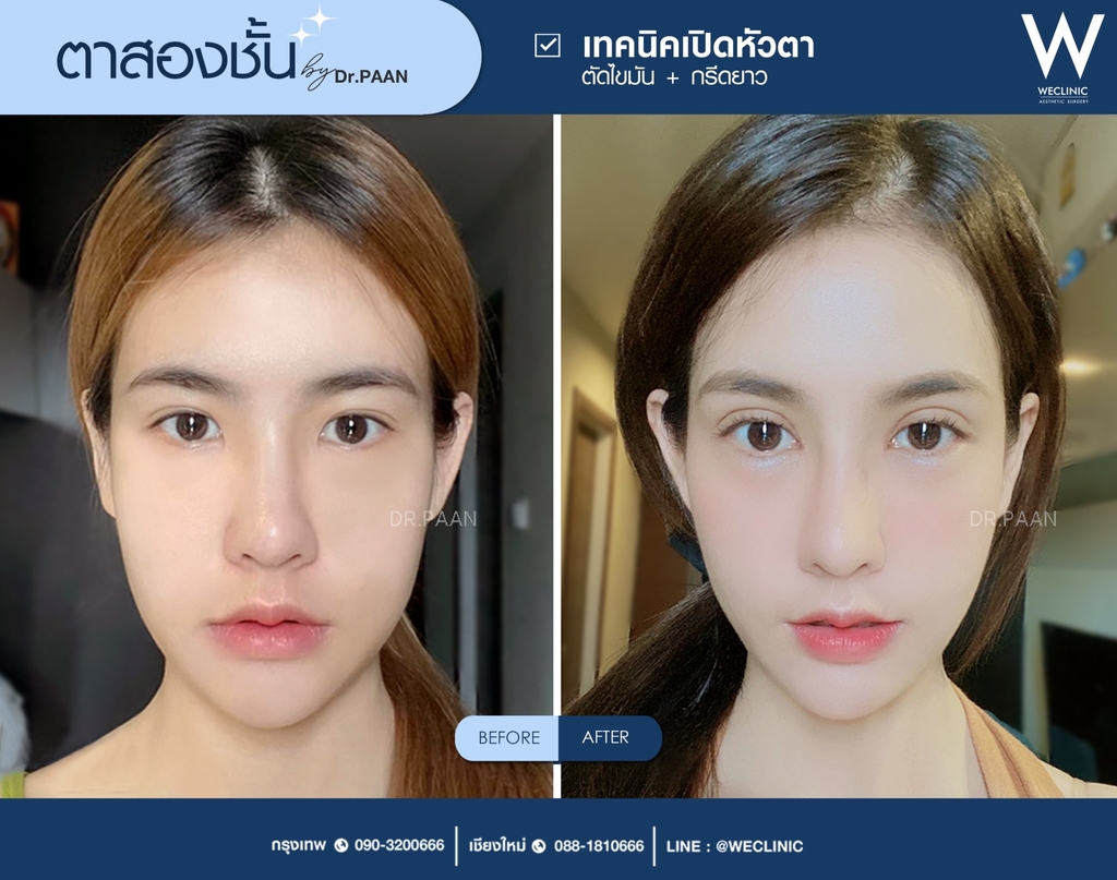 รีวิวตาสองชั้น-e05