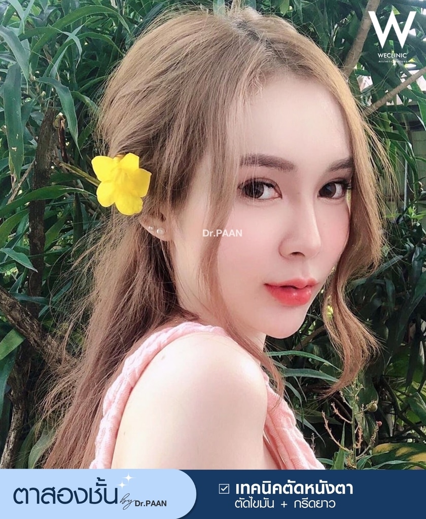 รีวิวศัลยกรรมตาสองชั้น-E27