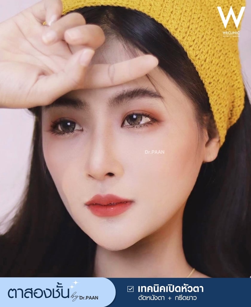 รีวิวศัลยกรรมตาสองชั้น-E28