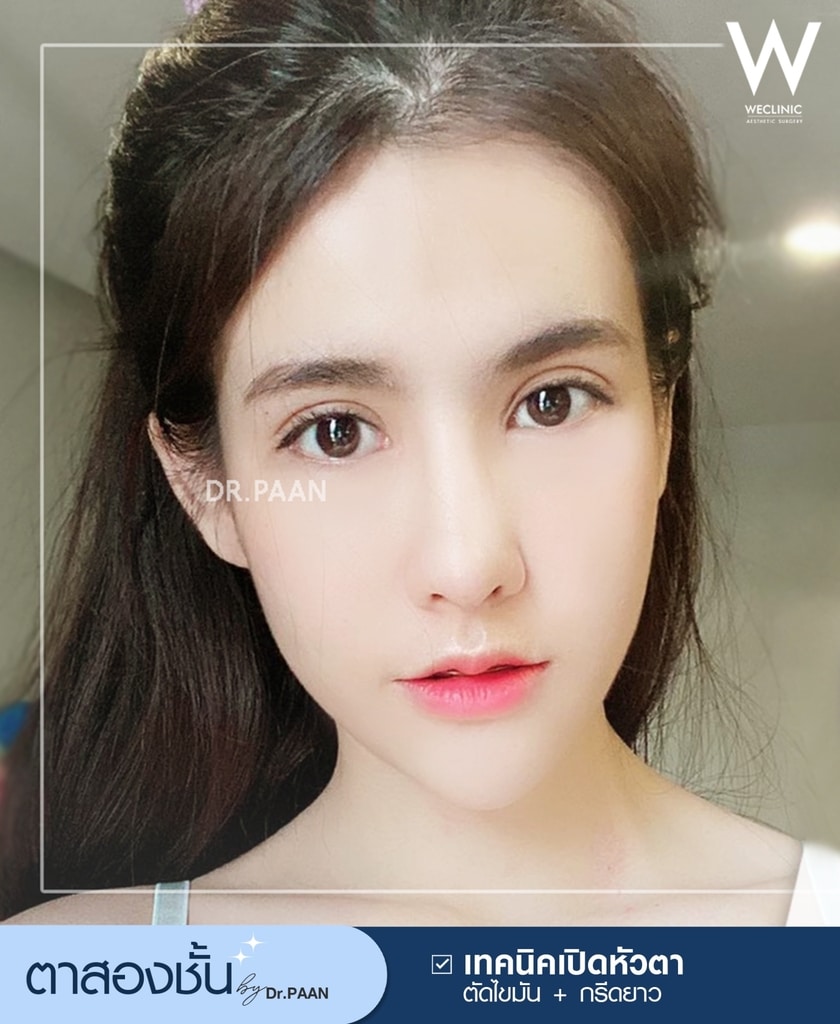รีวิวศัลยกรรมตาสองชั้น-E29