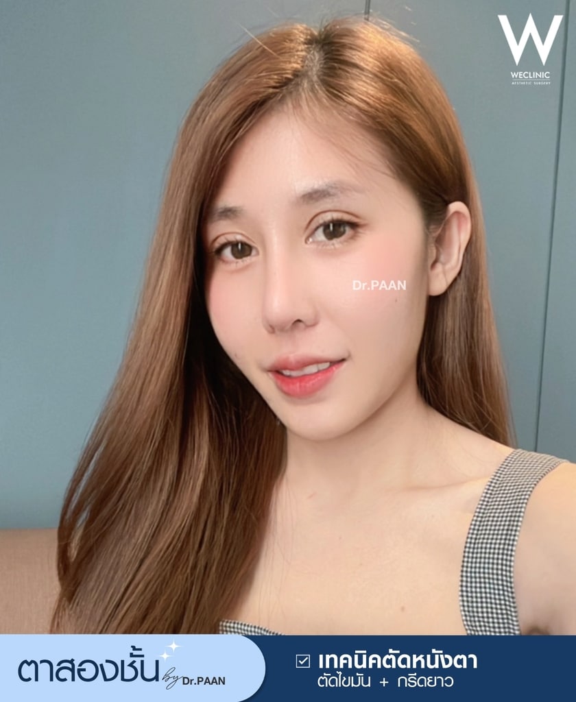 รีวิวศัลยกรรมตาสองชั้น-E31