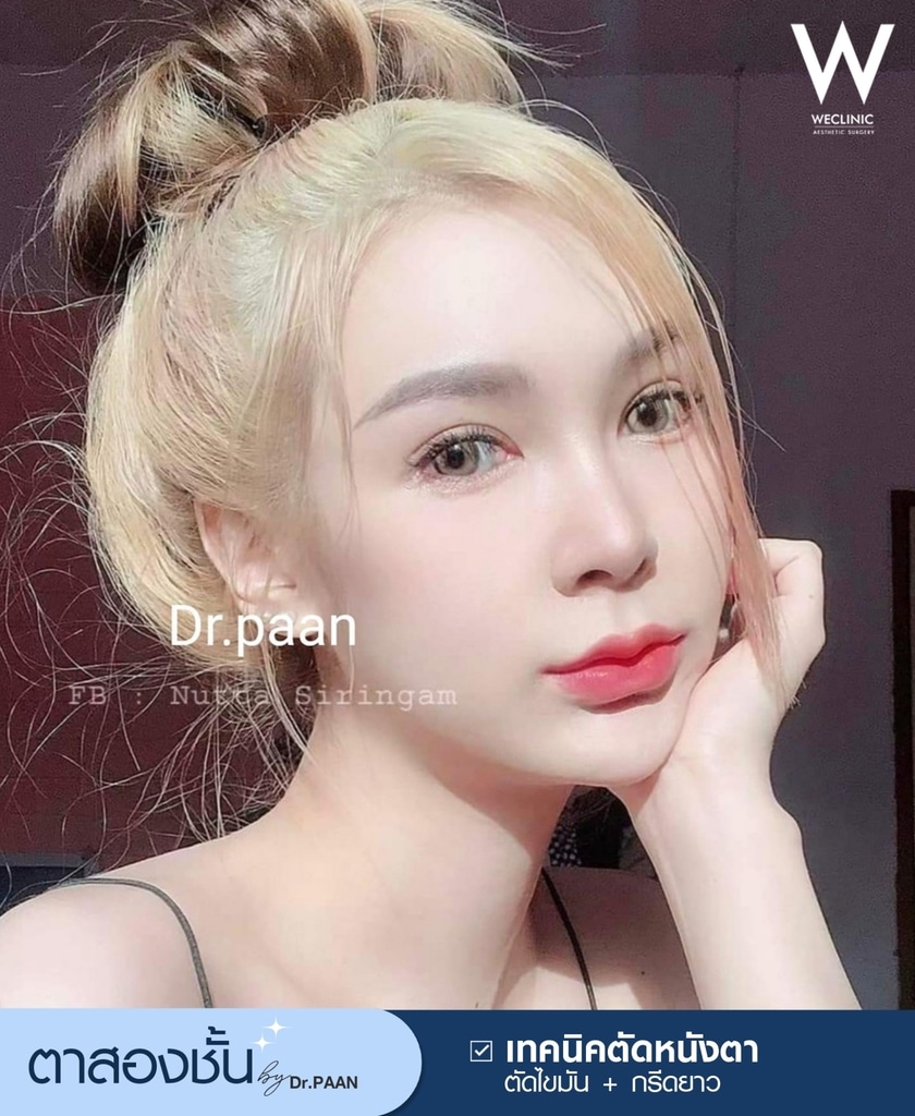 รีวิวศัลยกรรมตาสองชั้น-E32