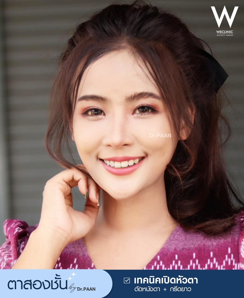 รีวิวศัลยกรรมตาสองชั้น-E33