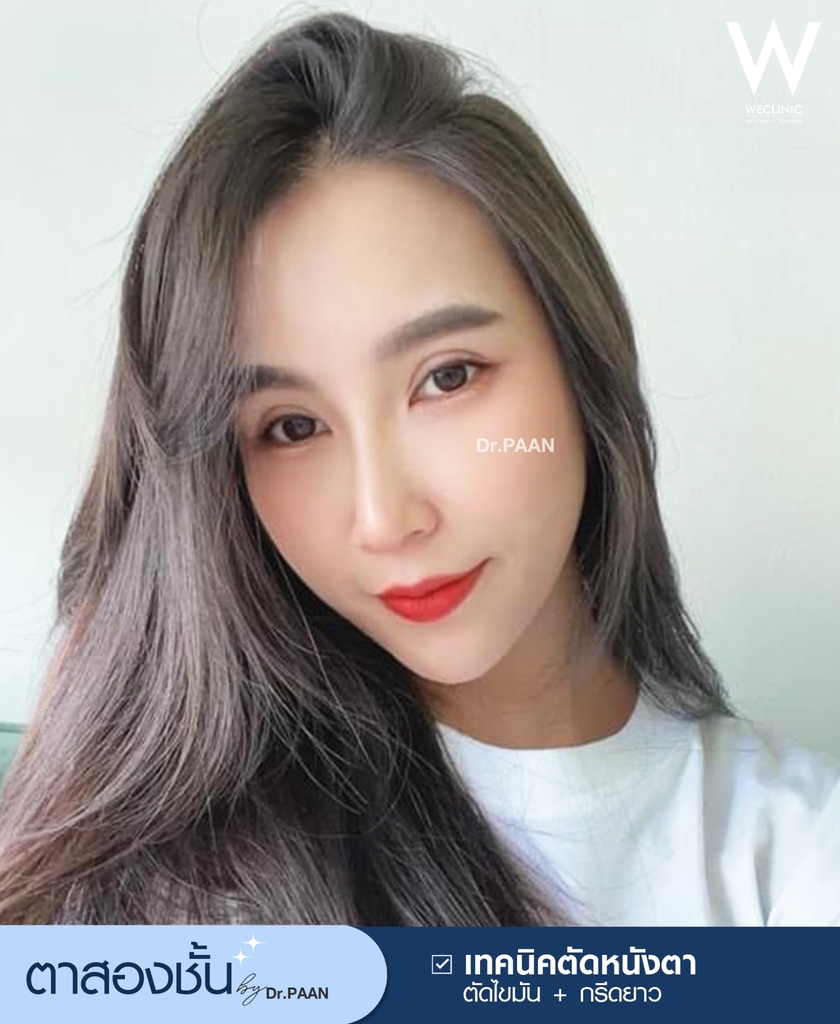 รีวิวศัลยกรรมตาสองชั้น-E34