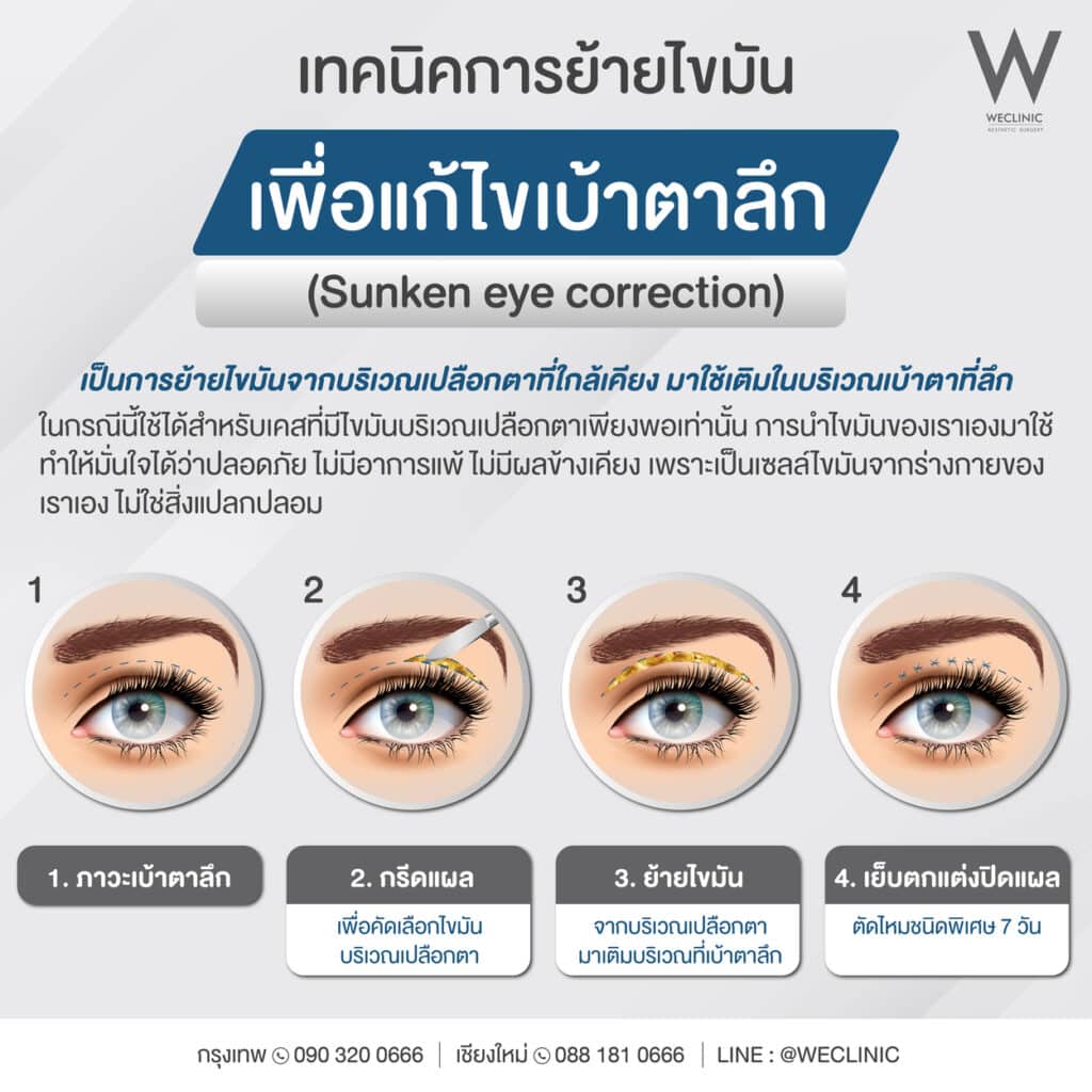 เทคนิคการย้ายไขมัน เพื่อแก้ไขเบ้าตาลึก