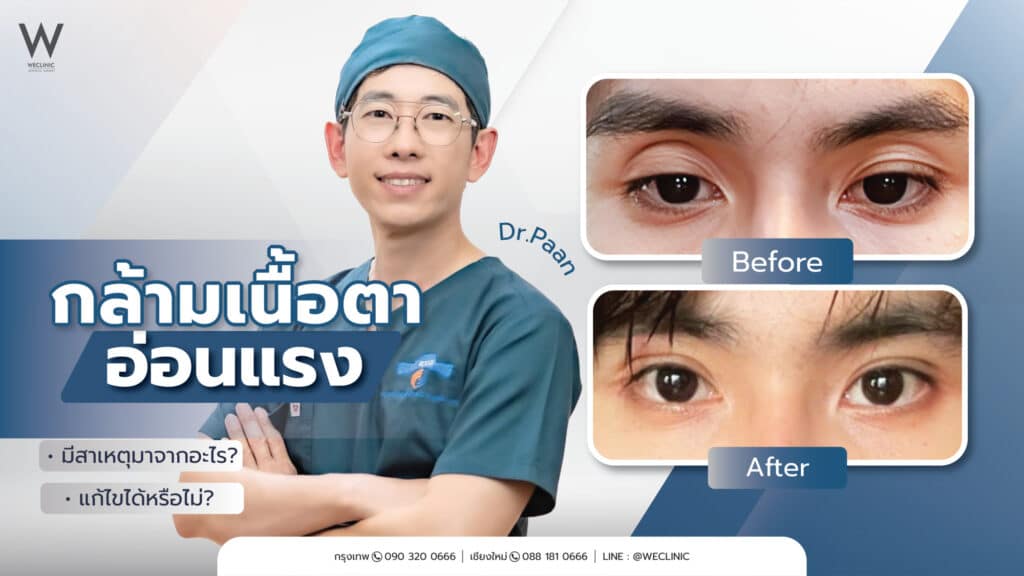 กล้ามเนื้อตาอ่อนแรง