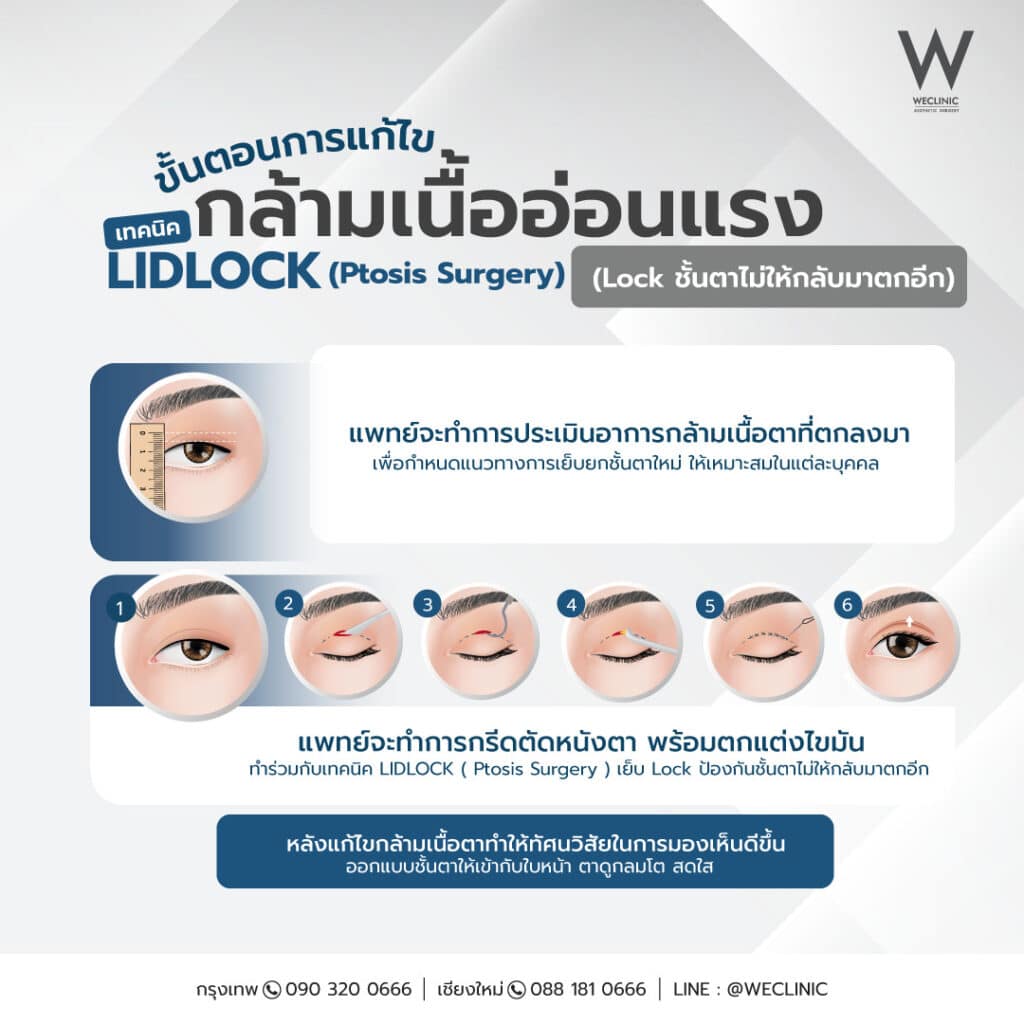 ขั้นตอนการแก้ไขกล้ามเนื้อตาอ่อนแรง