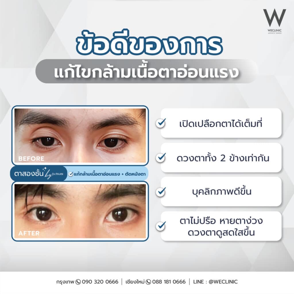 ข้อดีของการแก้ไขกล้ามเนื้อตาอ่อนแรง