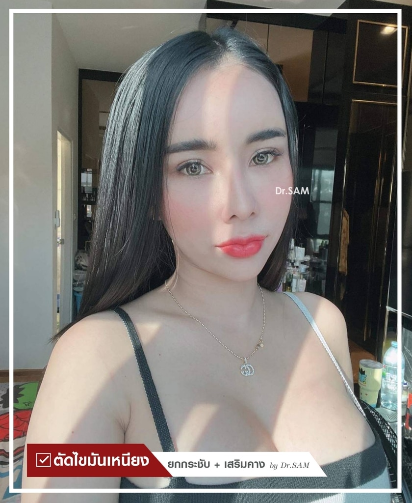 รีวิวตัดไขมันเหนียง-01