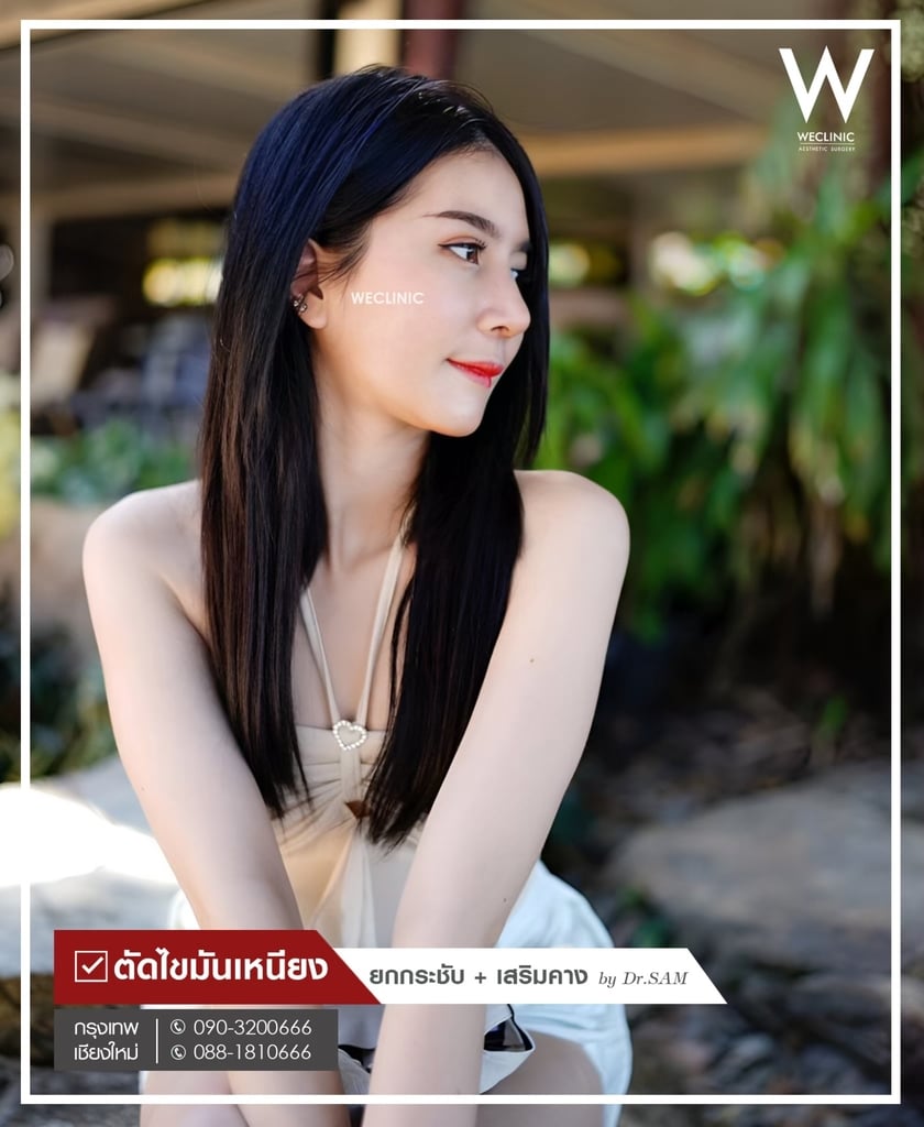 รีวิวตัดไขมันเหนียง-02