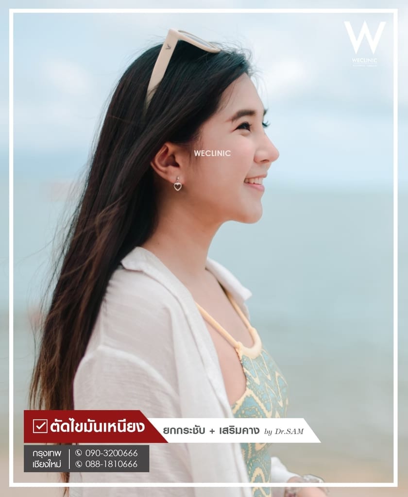 รีวิวตัดไขมันเหนียง-03