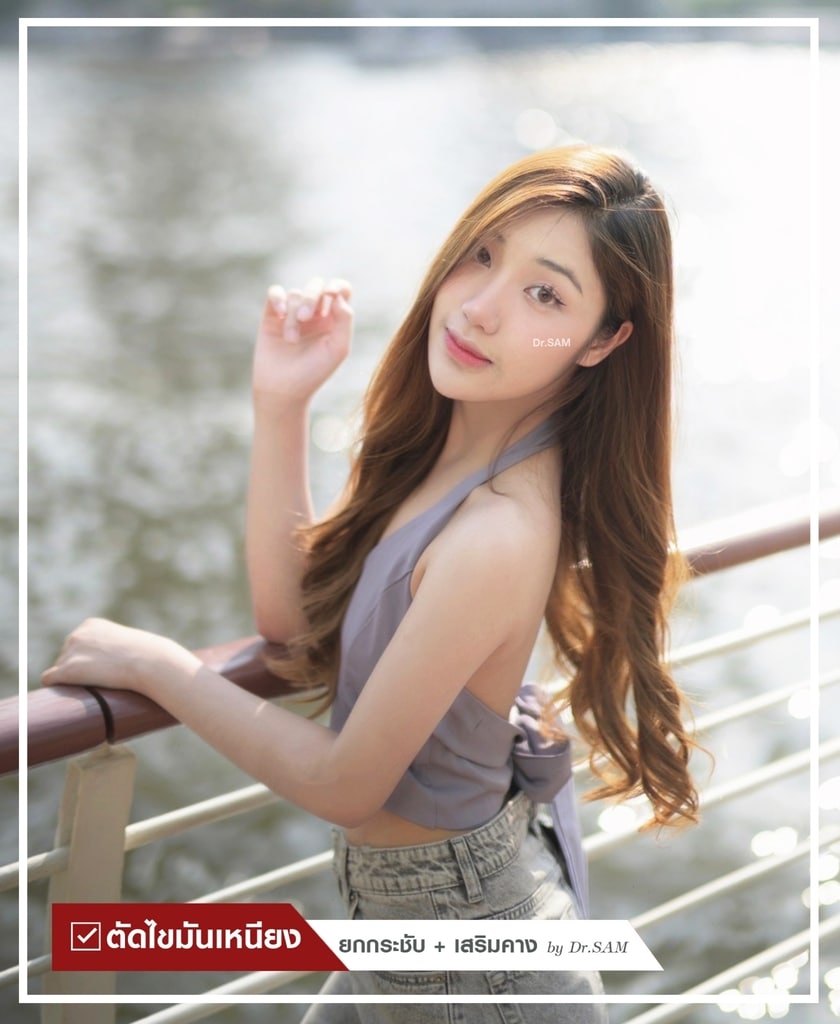 รีวิวตัดไขมันเหนียง-04