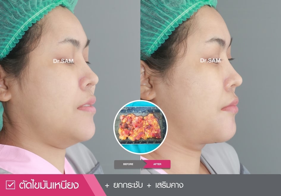 รีวิวลดเหนียง-04