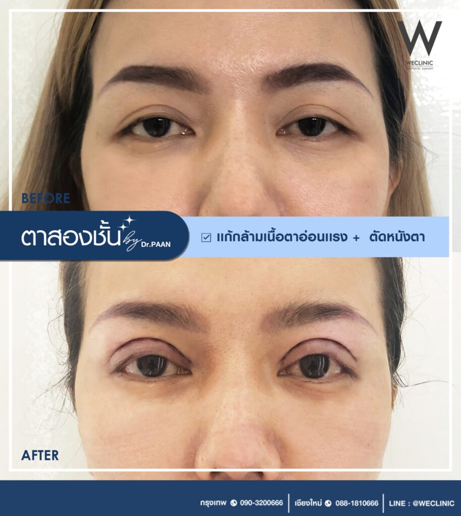 แก้กล้ามเนื้อตาอ่อนแรง