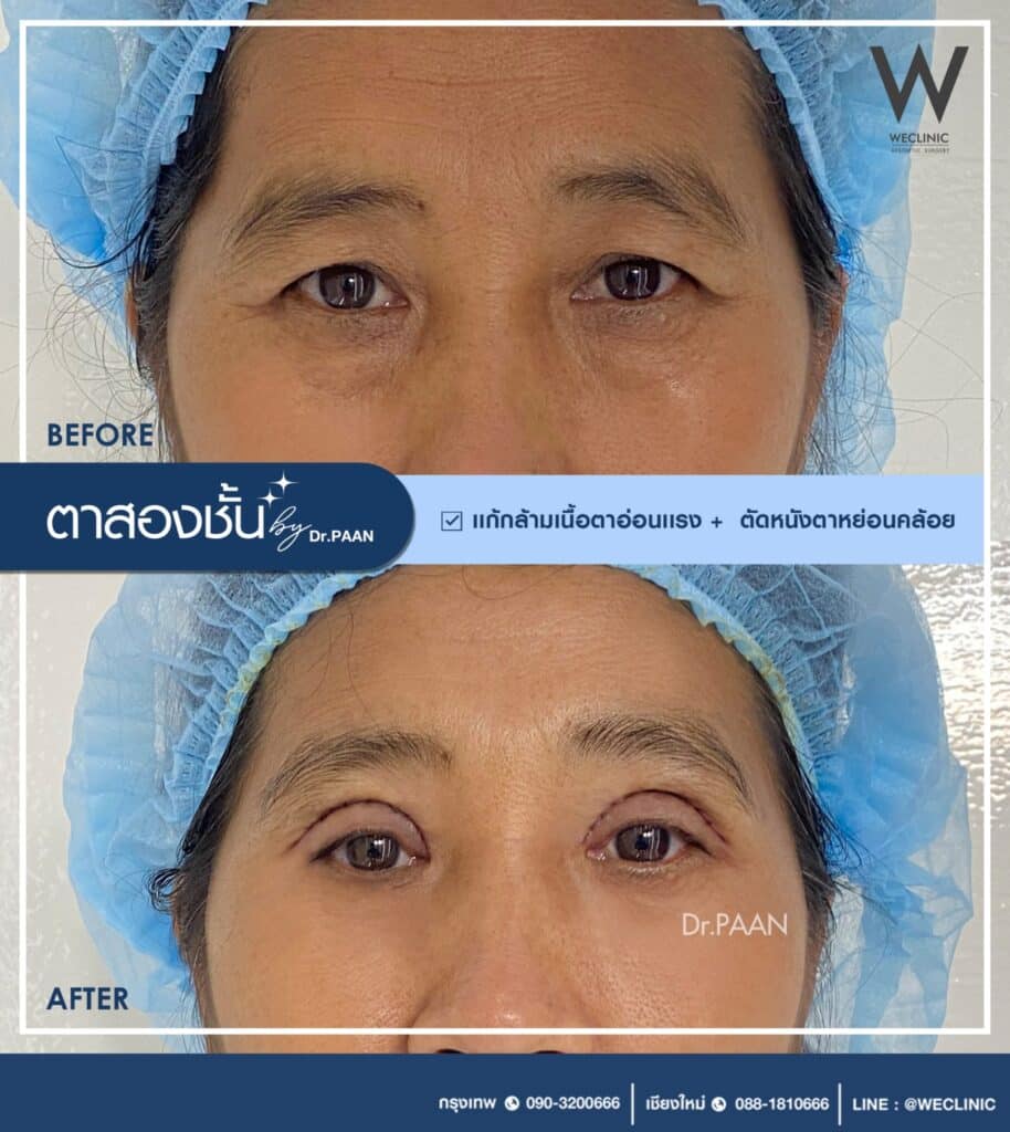 แก้ผิวหนังที่เปลือกตาหย่อน