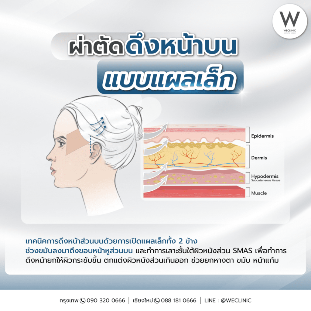 ผ่าตัดดึงหน้าบนแบบแผลเล็ก