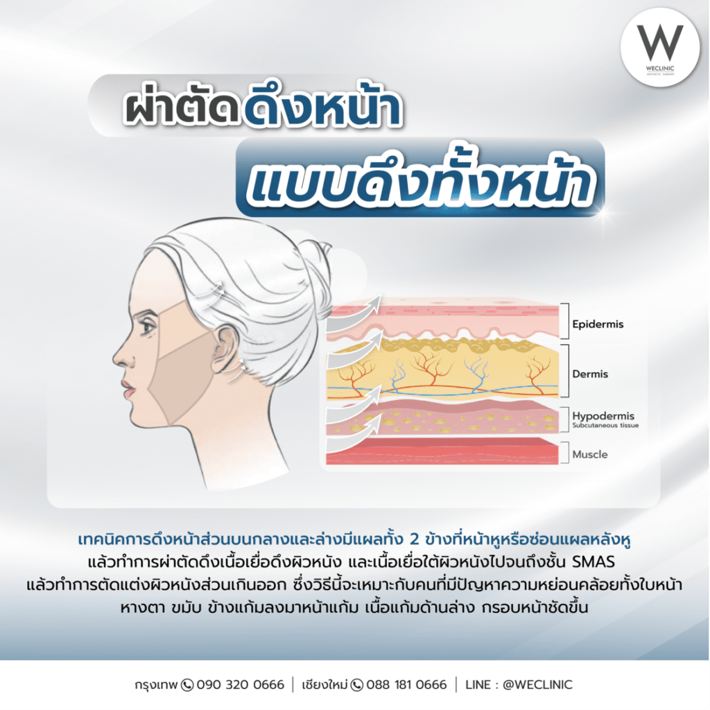 ผ่าตัดดึงหน้าแบบดึงทั้งหน้า