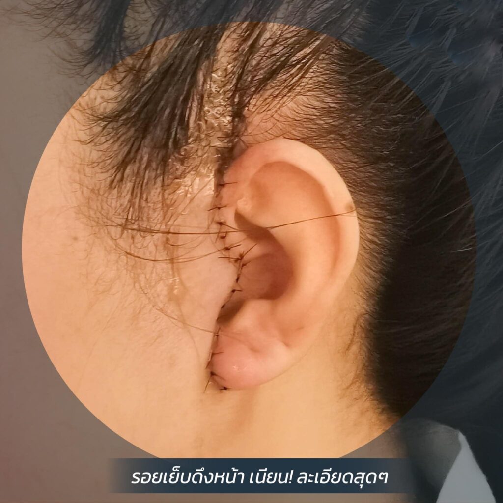 รอยเย็บดึงหน้าเนียน