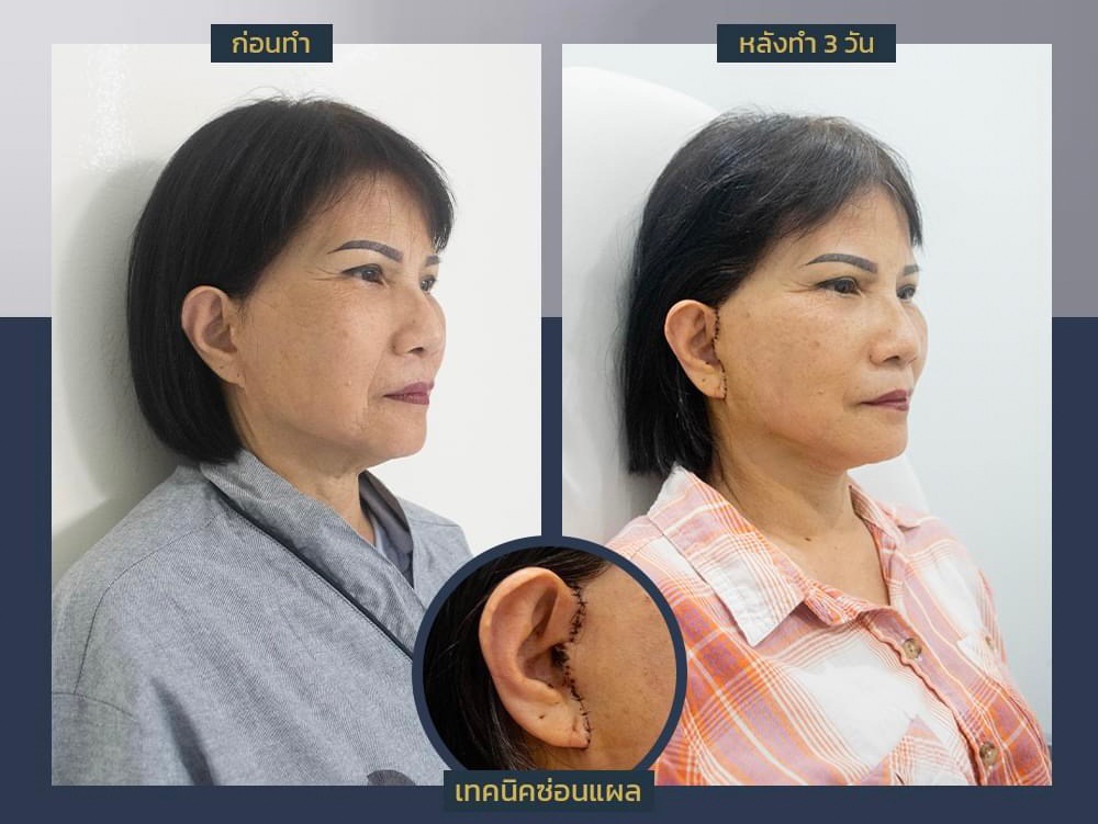 รีวิวดึงหน้าก่อนและหลังทำ-2