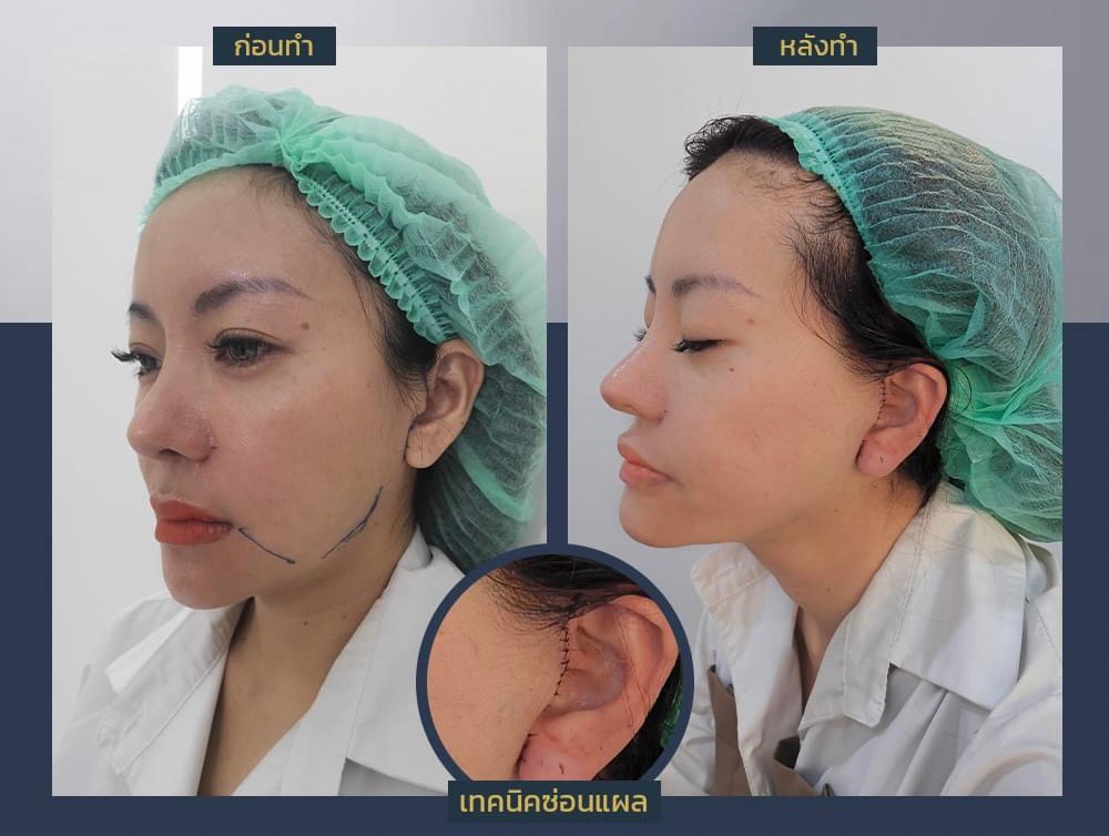 รีวิวดึงหน้าก่อนและหลังทำ-3