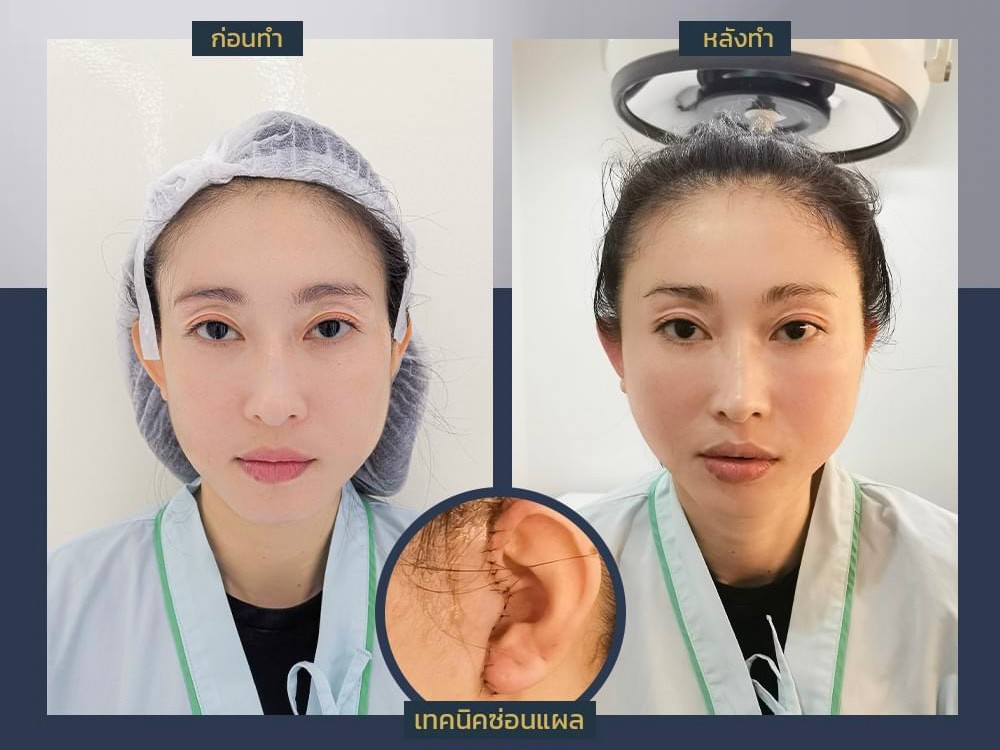 รีวิวดึงหน้าก่อนและหลังทำ