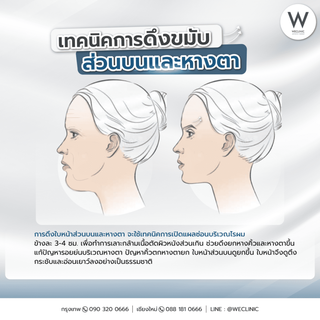 เทคนิคการดึงขมับส่วนบนและหางตา