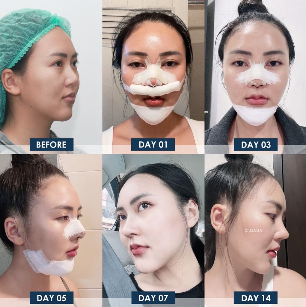 รีวิวทำคาง 14 วัน