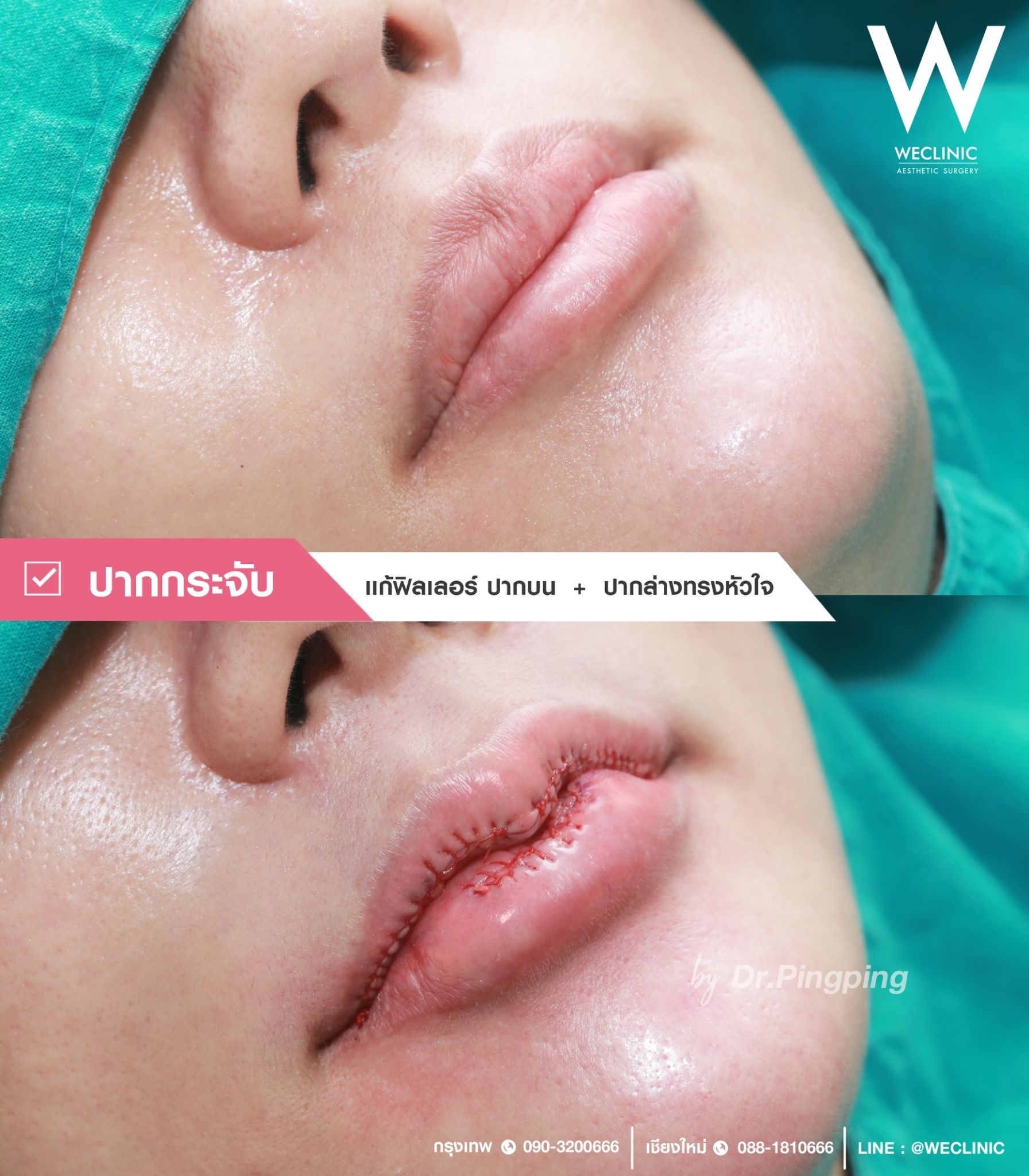 ทำปากกระจับ ช่วยอะไรบ้าง ข้อดี-ข้อเสีย เป็นอย่างไร