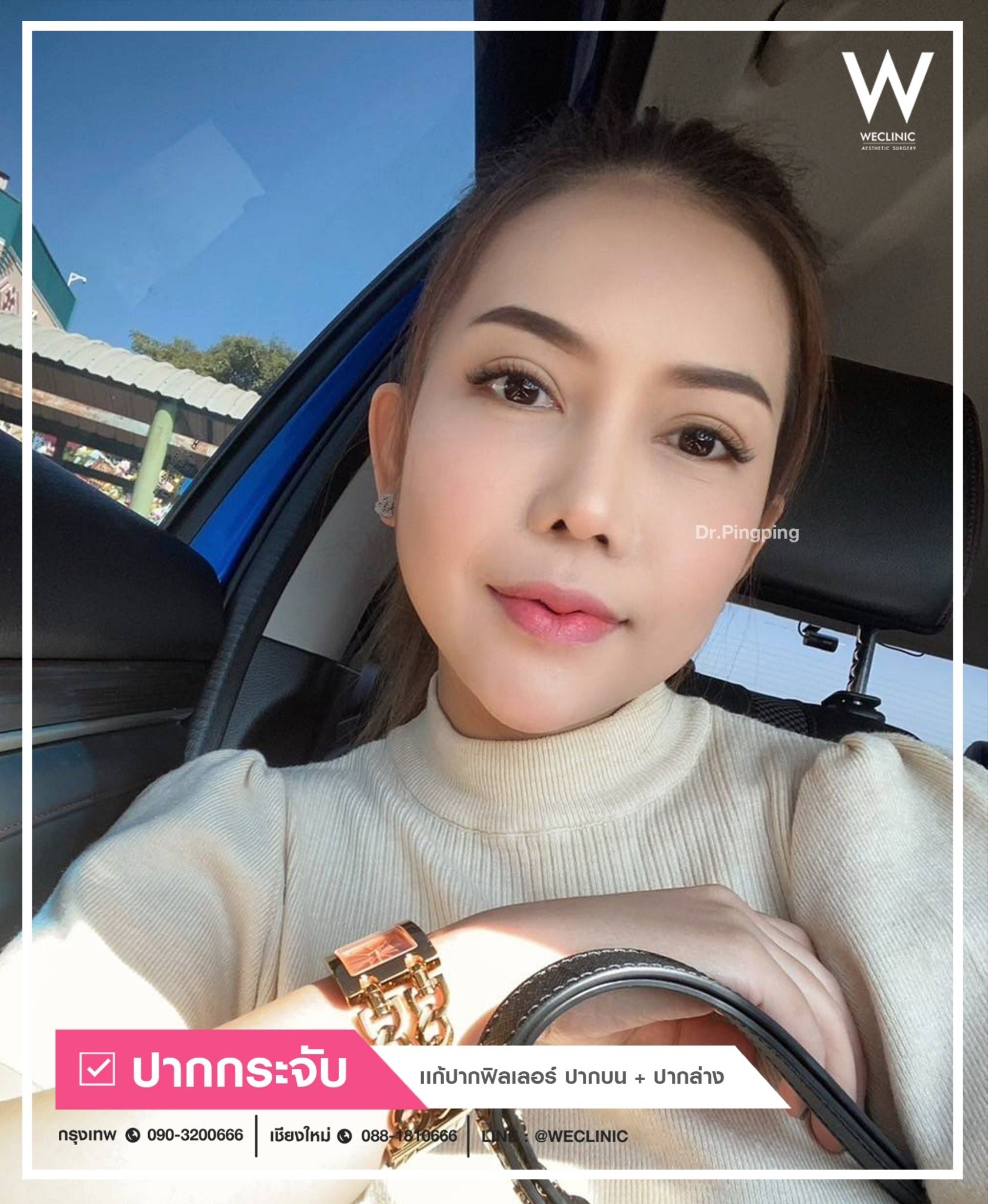 รีวิวปากกระจับ แก้ปากฟิลเลอร์ ปากบน ปากล่าง