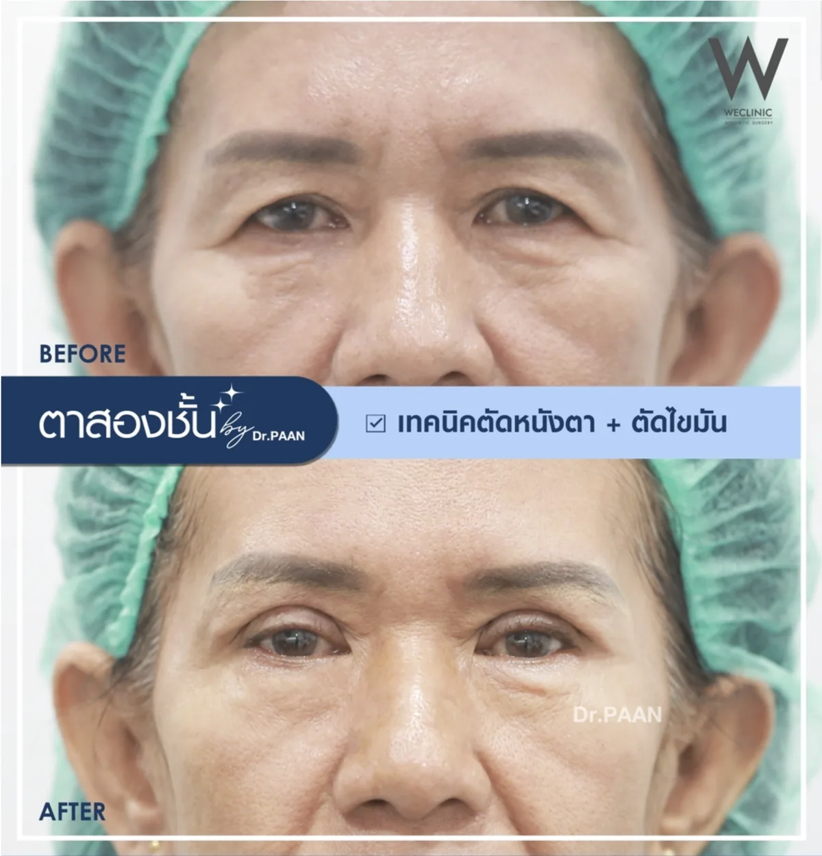 blepharoplasty-fat-removal-senior-before-after