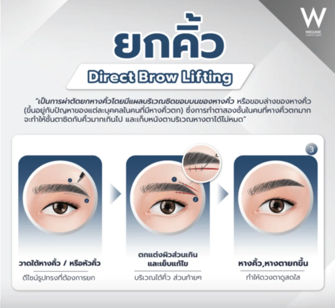 direct-brow-lift-technique