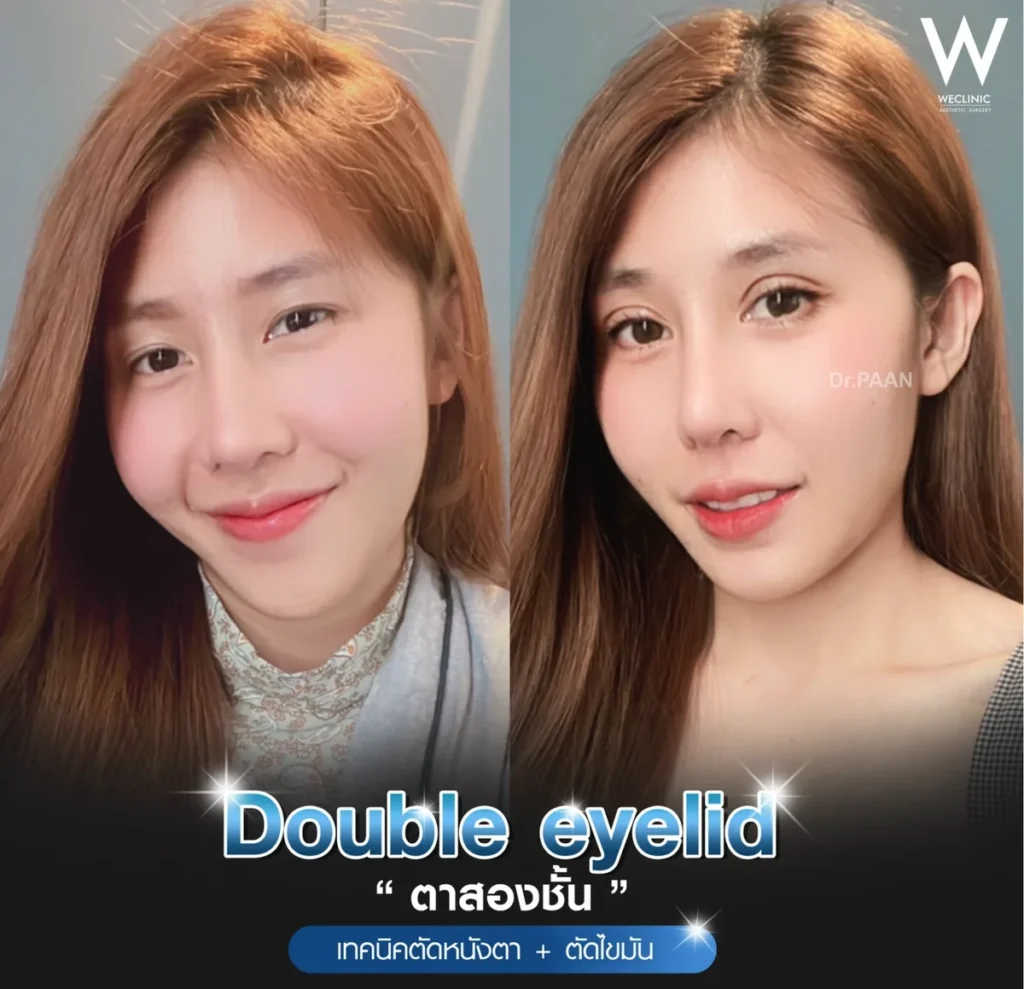 double-eyelid-blepharoplasty-fat-removal-before-after-01