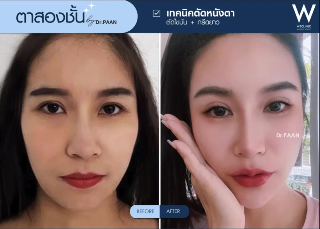 double-eyelid-blepharoplasty-fat-removal-before-after-03
