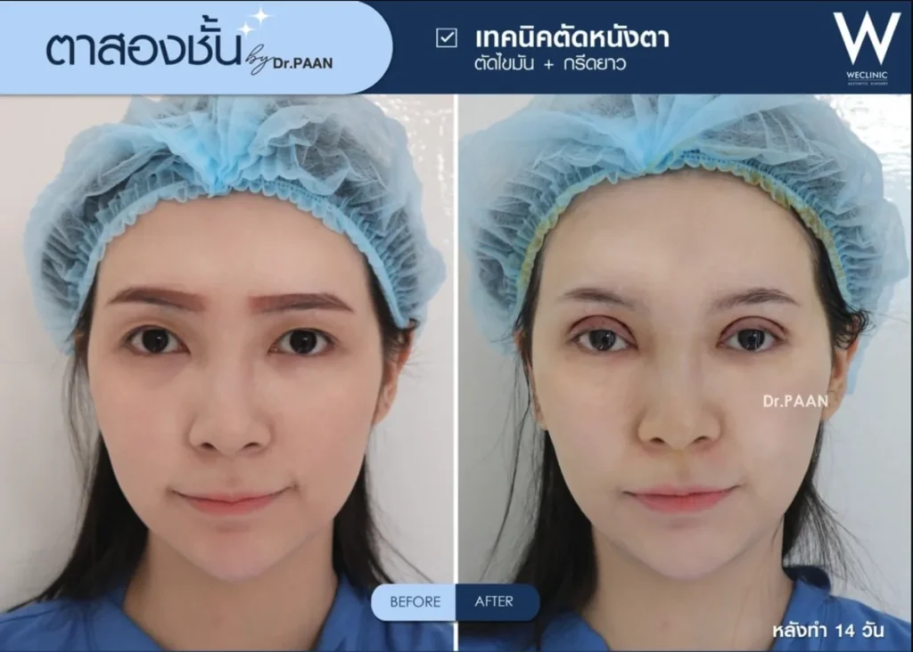 double-eyelid-blepharoplasty-fat-removal-before-after-04