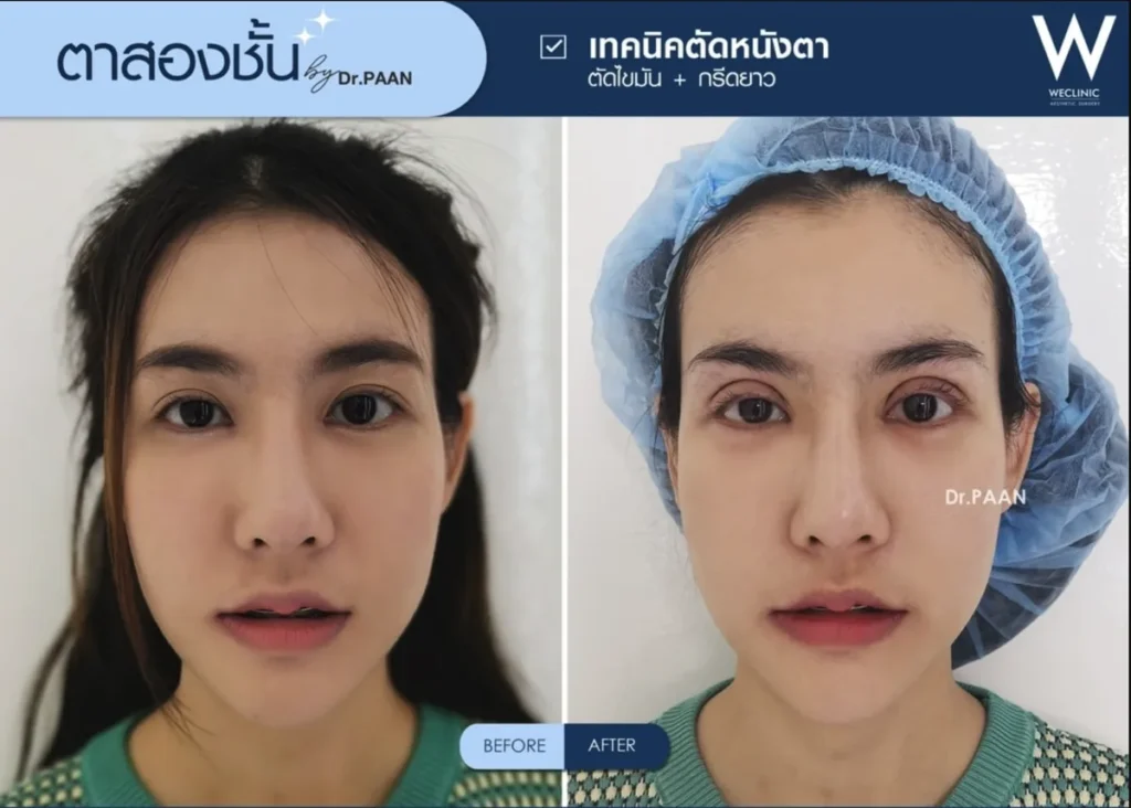 double-eyelid-blepharoplasty-fat-removal-before-after-05