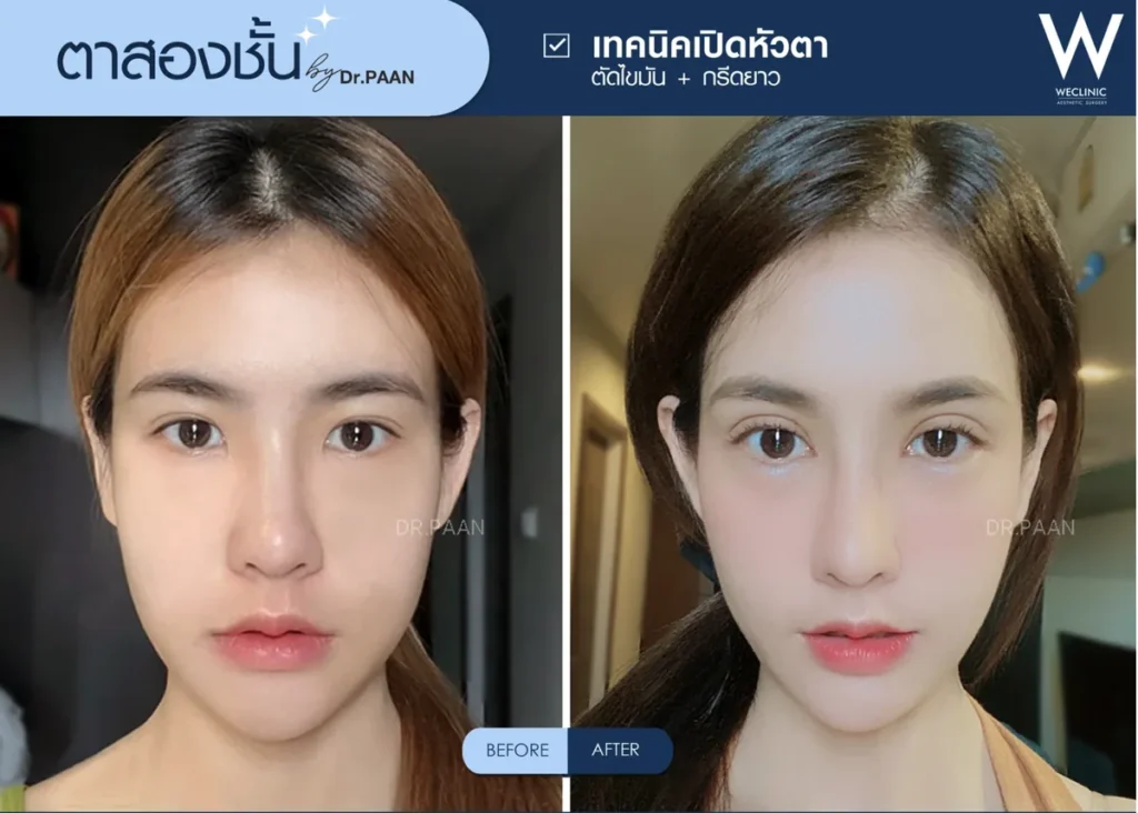 double-eyelid-epicanthoplasty-before-after-01