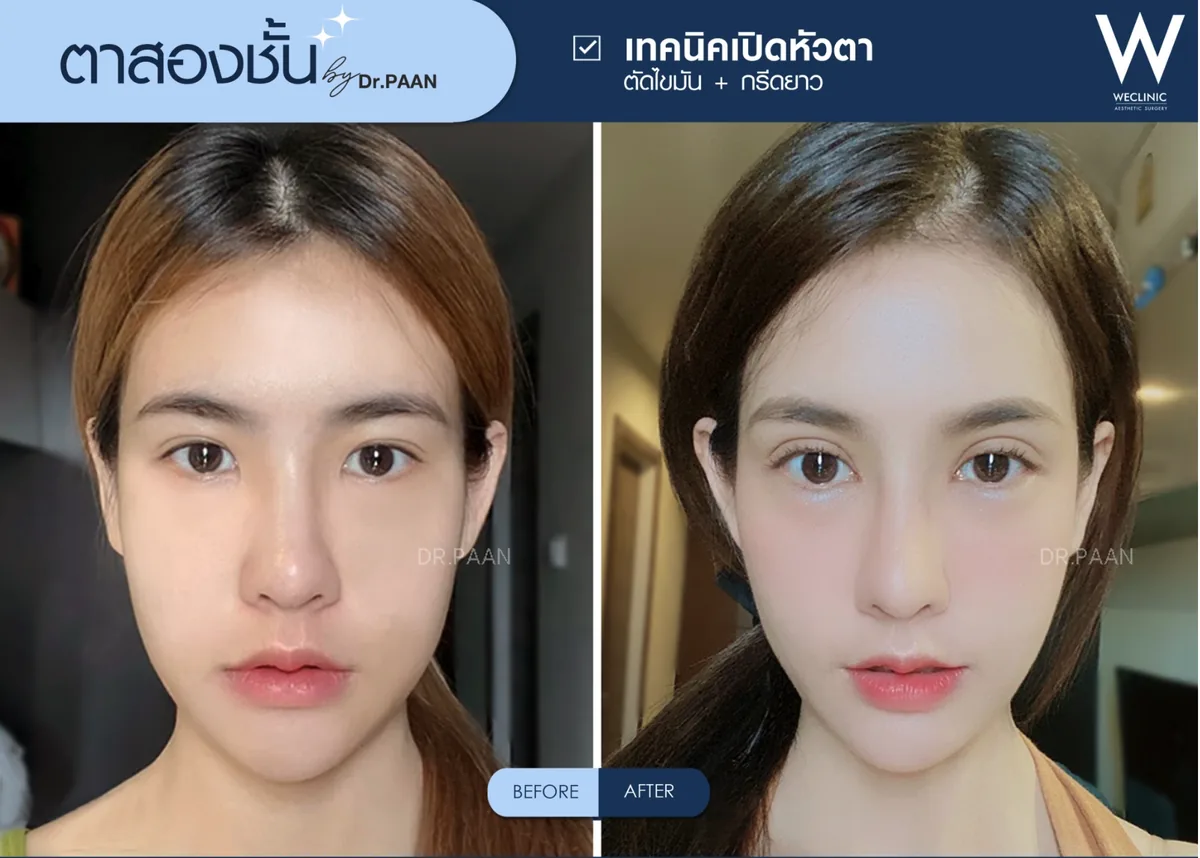 double-eyelid-epicanthoplasty-before-after-01