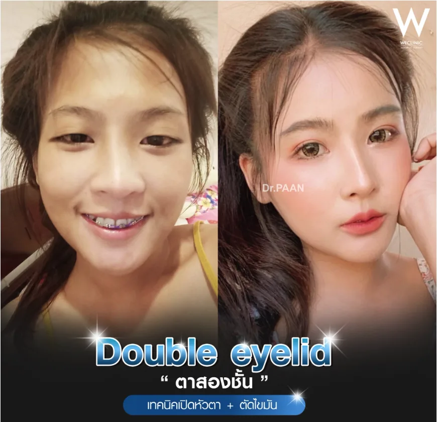 double-eyelid-epicanthoplasty-before-after-02