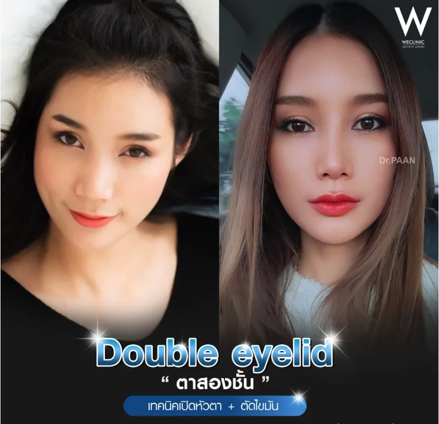 double-eyelid-epicanthoplasty-before-after-03