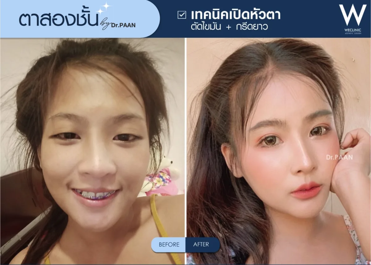 double-eyelid-epicanthoplasty-before-after-04