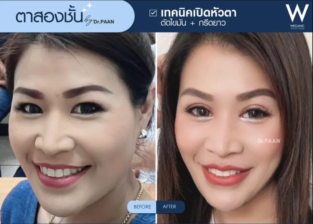 double-eyelid-epicanthoplasty-before-after-05