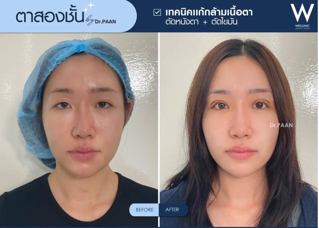 double-eyelid-ptosis-correction-before-after-01