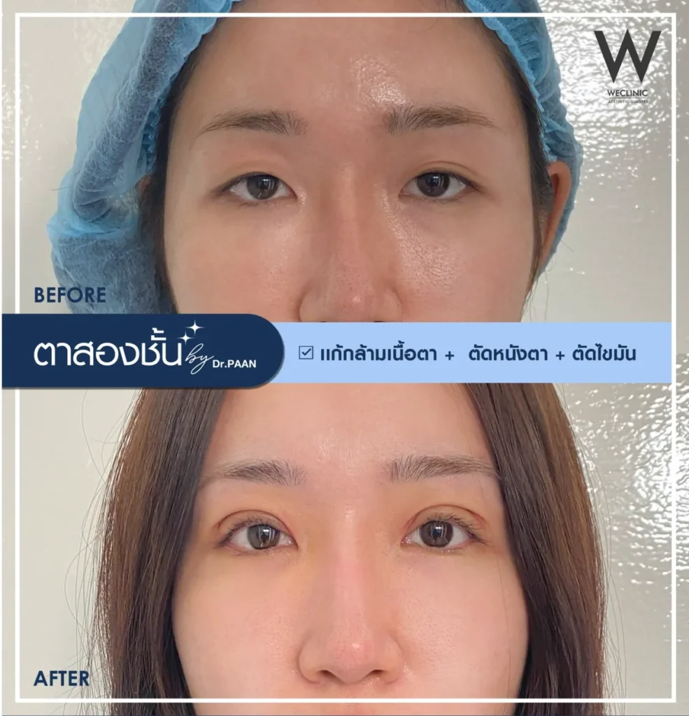 double-eyelid-ptosis-correction-before-after-02