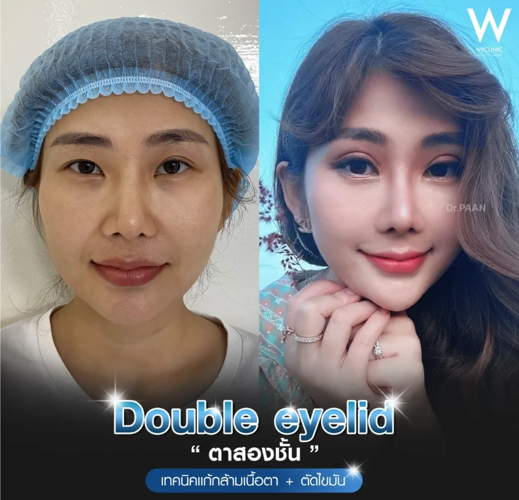 double-eyelid-ptosis-correction-before-after-03