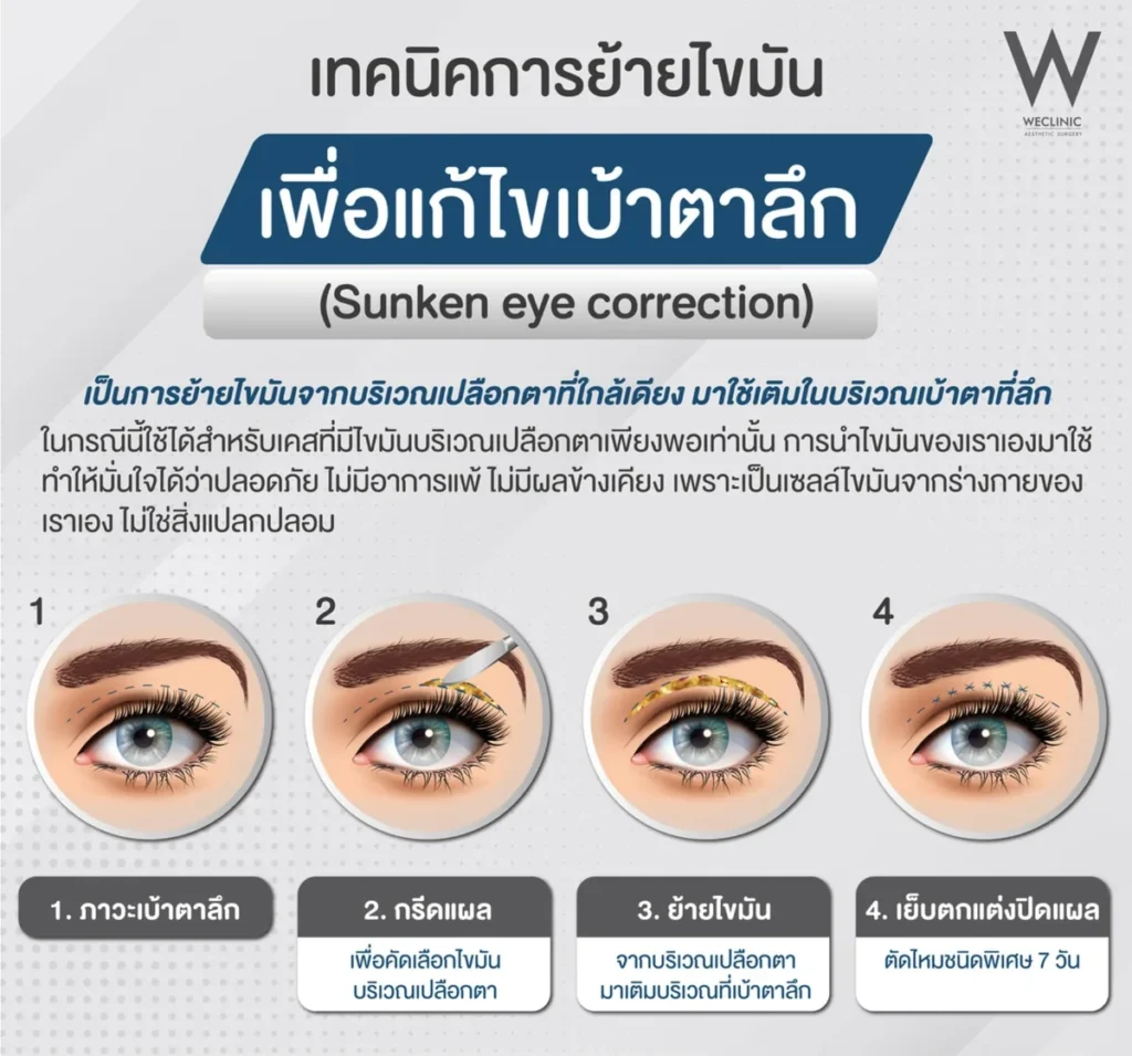 double-eyelid-ptosis-correction-before-after-06